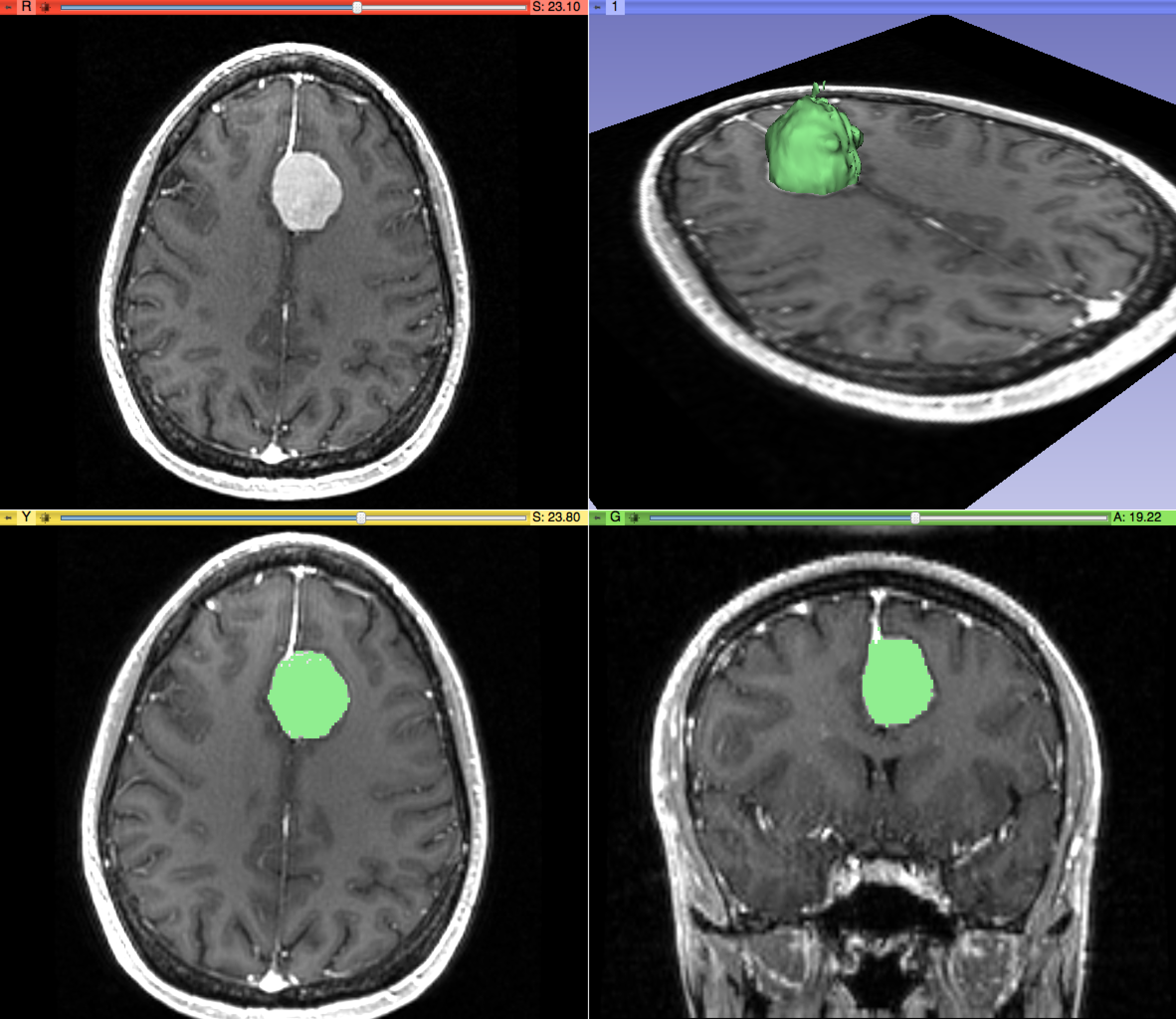 Semantic Segmentation in Medical Imaging: Revolutionizing Diagnostics